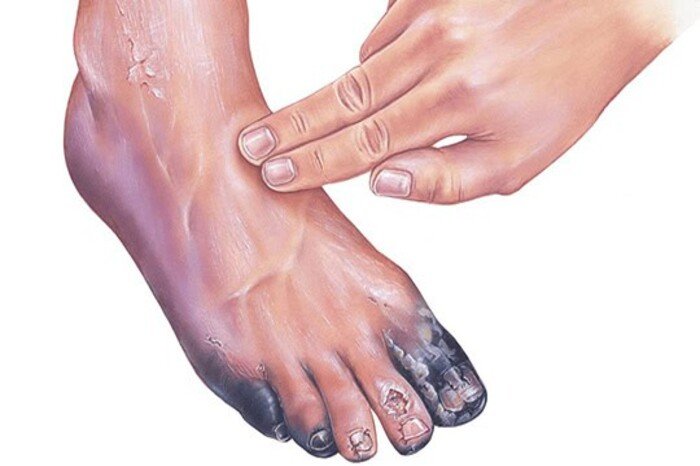 Service Provider of Gangrene Treatment in New Delhi, Delhi, India.